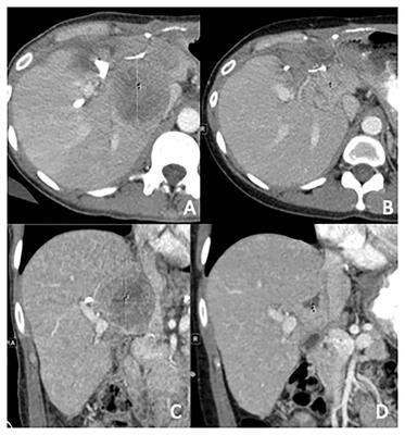 Case report: Metastatic BRAF V600E–mutated adult Wilms’ tumor with robust response to BRAF/MEK inhibitor therapy